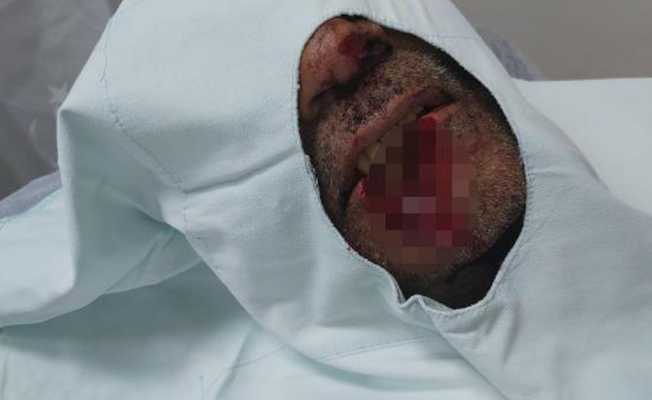 Kayınpederinin alt dudağını ısıran damat: Nasıl oldu hatırlamıyorum
