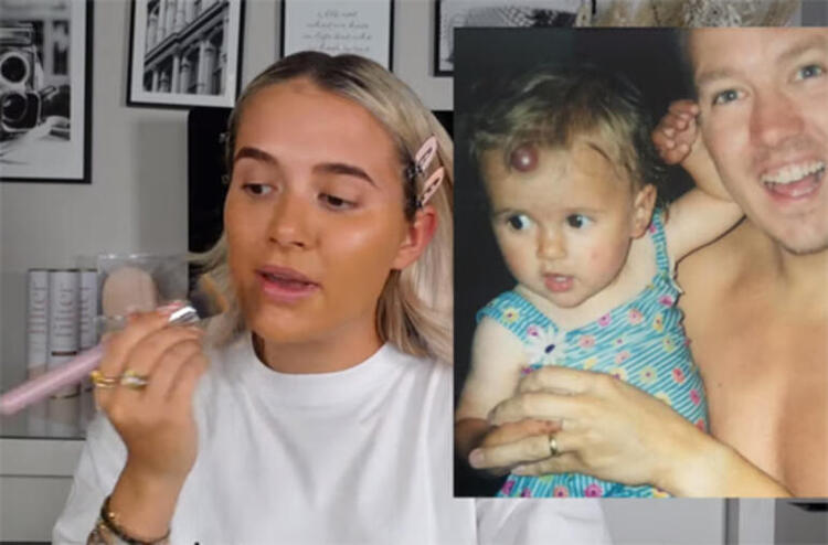 Molly Mae Hague doğum lekesini neden aldırdı?