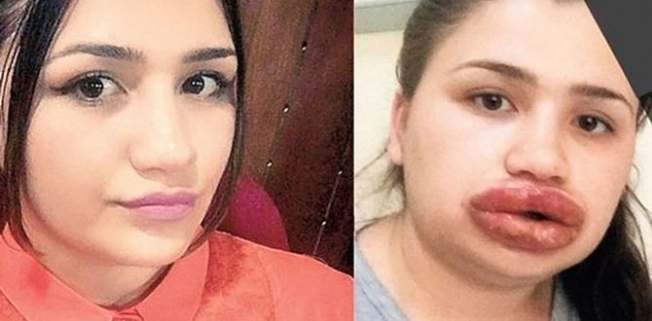 Kuaförde yaptırdığı silikon dudaklarına mal olabilir