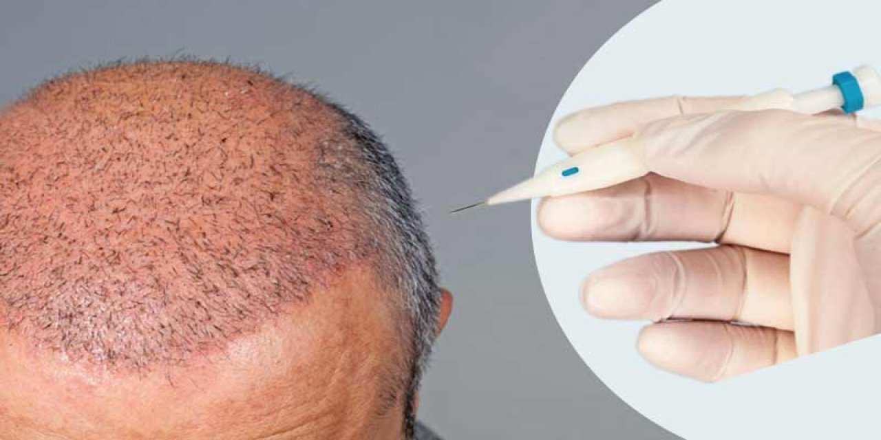 تكلفة زراعة الشعر في تركيا