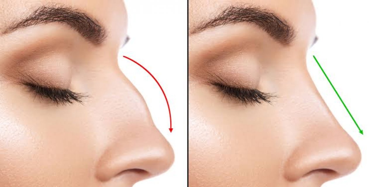 Burun Estetiği Yöntemleri Nelerdir? - Estevien Clinic