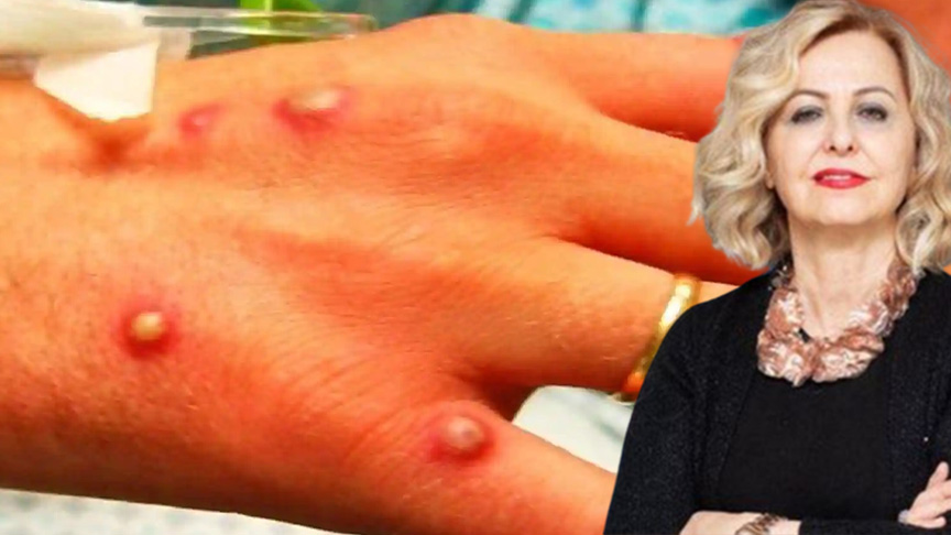 Ünlü profesörden maymun çiçeği virüsü uyarısı: Bu böyle sürerse dünya...