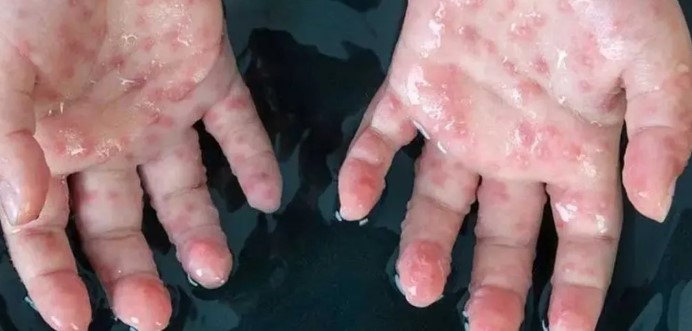 Maymun çiçeği virüsü Türkiye'de görüldü mü? Sağlık Bakanlığı'ndan açıklama geldi