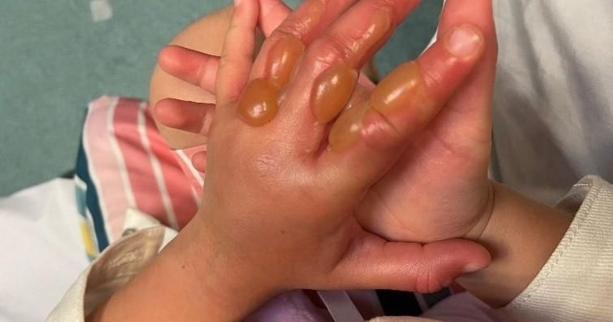 Dokunursanız sakın güneşe çıkmayın! Türkiye'de de olan çocuk dokunan bebek bu hale geldi