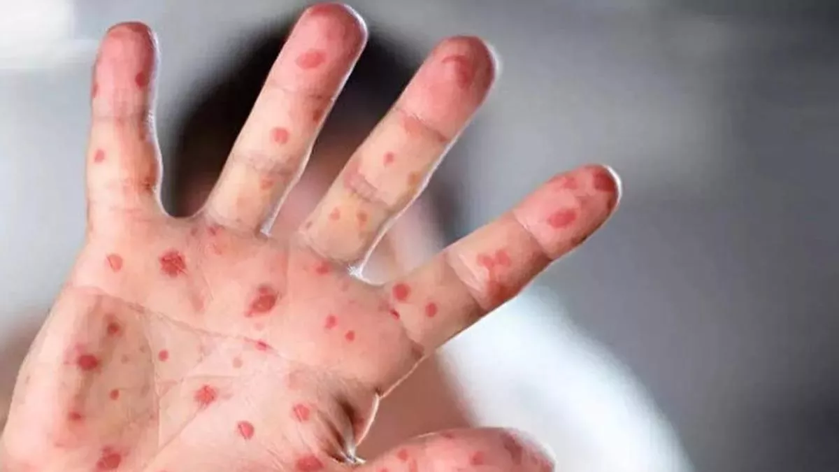 Bilim insanlarından maymun çiçeği uyarısı: 10 kat artabilir