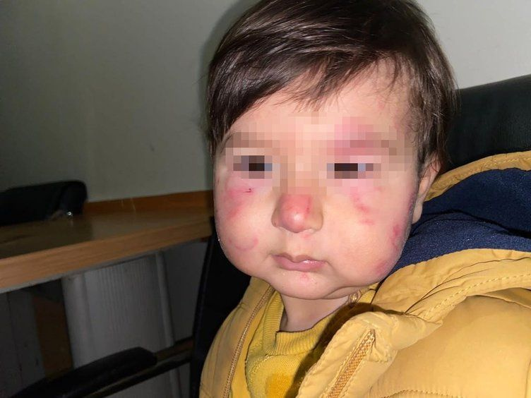 17 aylık bebek kreşte darp edildi! Yaralarını makyajla kapatmaya çalıştılar