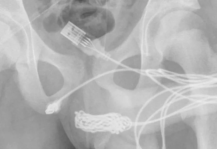 Doktorları şoke etti: Penisinden USB kablosu çıktı