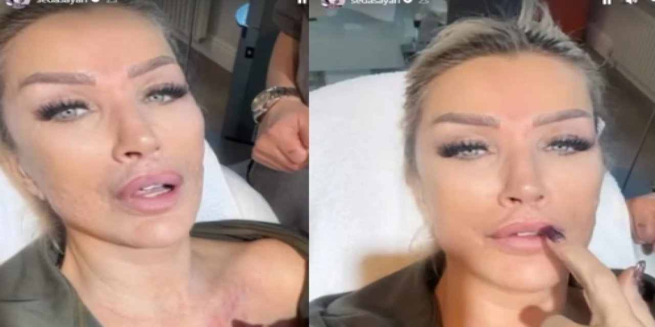 Seda Sayan suratına sünnet derisinden öyle bir şey yaptı ki...