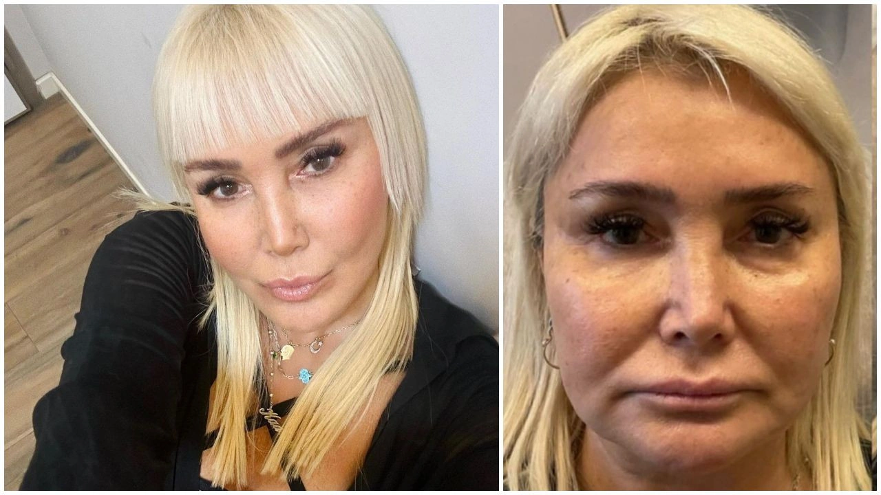 Yonca Evcimik bebek kordonuyla estetik yaptırdı: Bundan sonra yaşlanmak yok