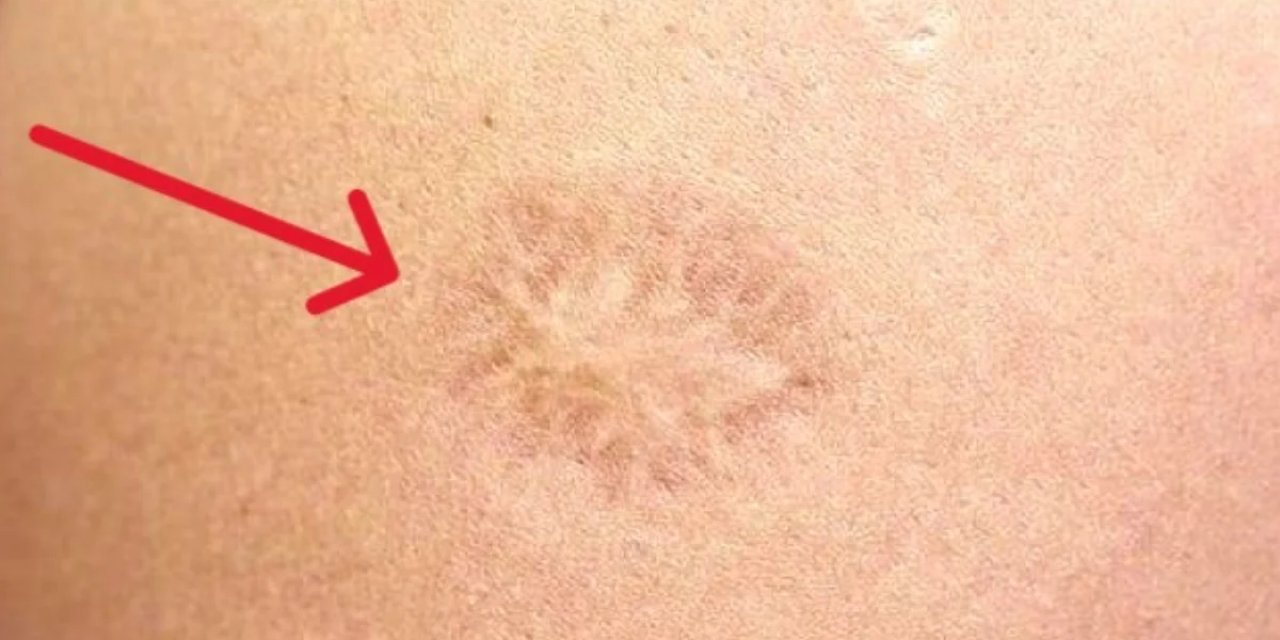 Çiçek aşısı, maymun çiçeği virüsünden korur mu? Türkiye'de en son çiçek aşısı kaç yılında yapıldı?