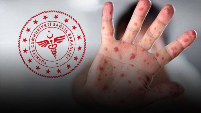 Beyoğlu'nda maymun çiçeği hastalığı mı görüldü? Bakanlıktan açıklama geldi