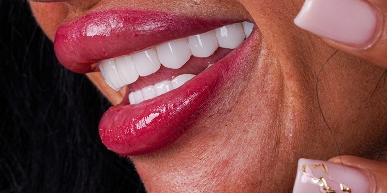 Hollywood Smile Yaptırmadan Önce Bilmeniz Gerekenler
