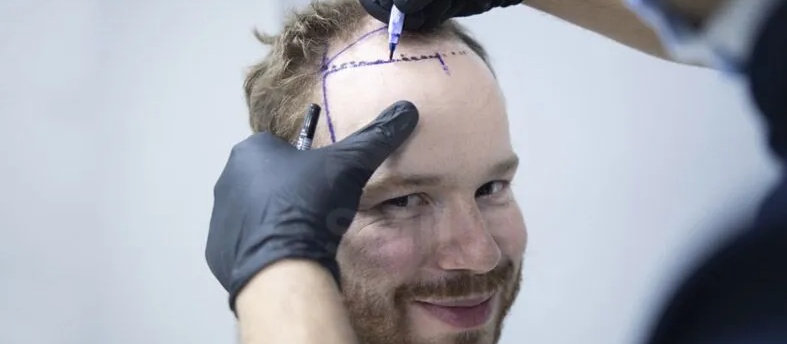 Saç Ekimi Rehberi: Smile Hair Clinic ile Kalıcı ve Doğal Sonuçlar