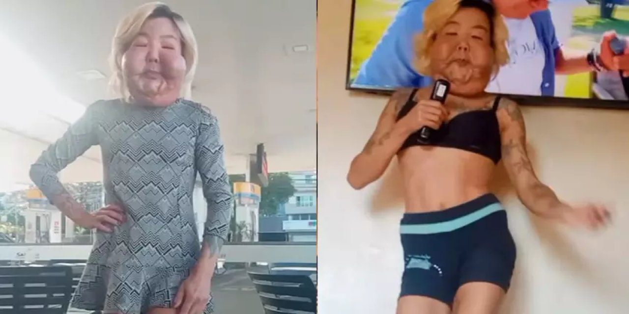 Estetikten yüzü şişip erimişti! Şimdi de göğüslerini yaptırdı