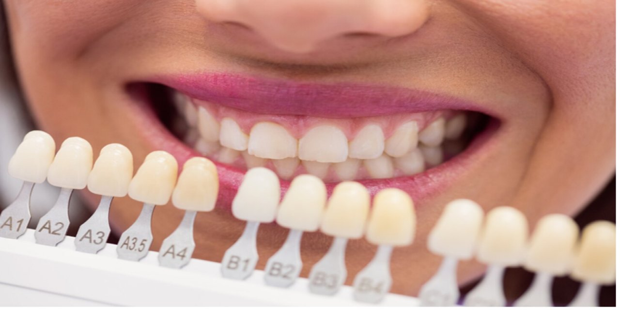 Lamina Veneer (Lamine Kaplama) Fiyatları #2026