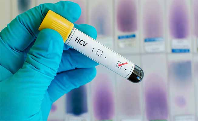 Hepatit virüsü her yıl 1.5 milyon insanın ölümüne neden oluyor