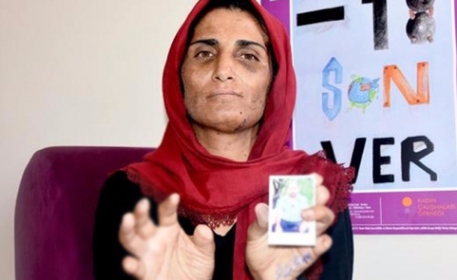Dini nikahla evlendirilen ve kocası tarafından 11 parmağı kesilen kadına, Aile Bakanlığı sahip çıktı