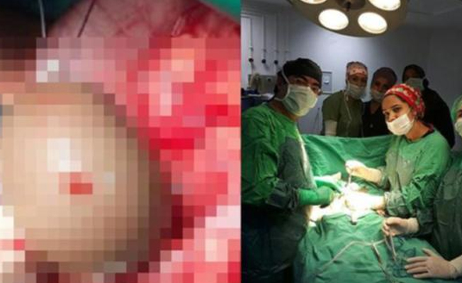 1.5 yaşındaki Mihriban'ın karnından 10 santim çapında kist çıktı