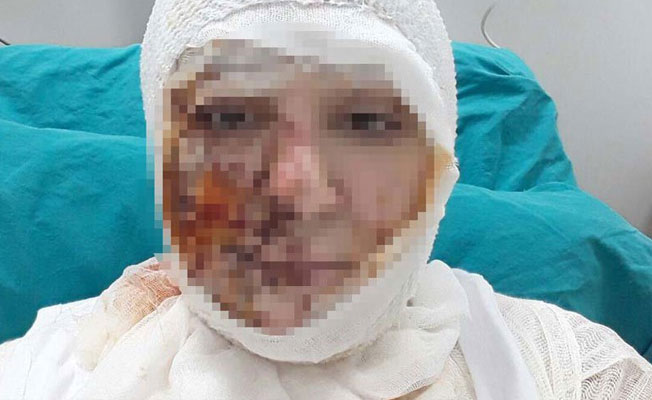 Savcı itiraz etti, kezzaplı saldırgan gözaltına alındı