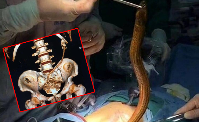 Anüsünden yılan balığı çıktı