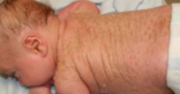 Siirt'te 'yılan bebek' dünyaya geldi