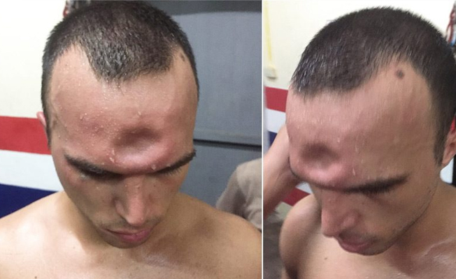 Muay Thai boksörünün korkunç sakatlığı