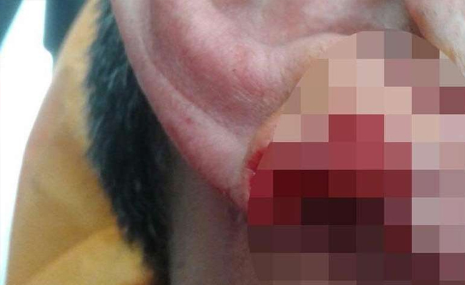 Kavga ettiği kişinin kulağını ısırarak kopardı