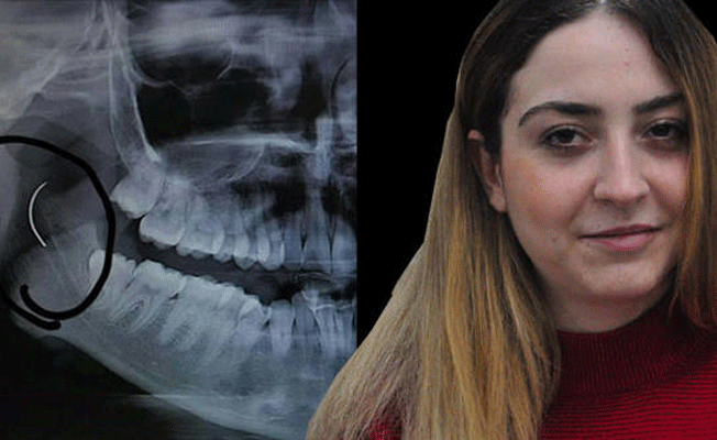İğneyi boğazında unuttular... Tam 18 yıl sonra alınabildi