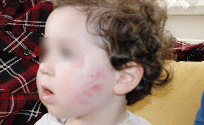 1,5 yaşındaki çocuğa kreşte dayak iddiasına soruşturma