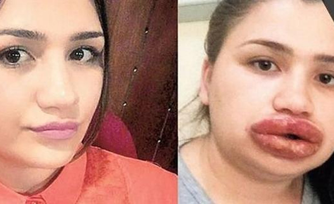 Dolgu mağduru o hemşirenin doktoru konuştu