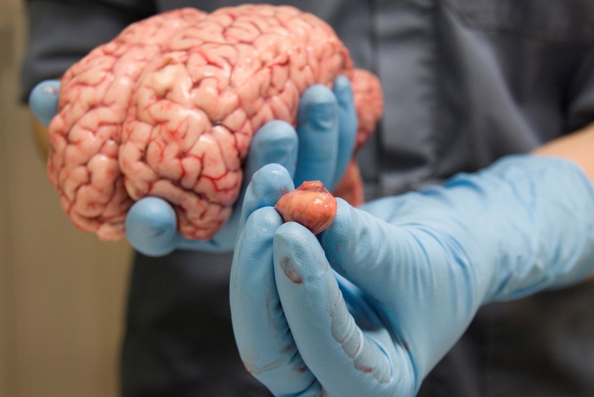 tumor-4864.jpg