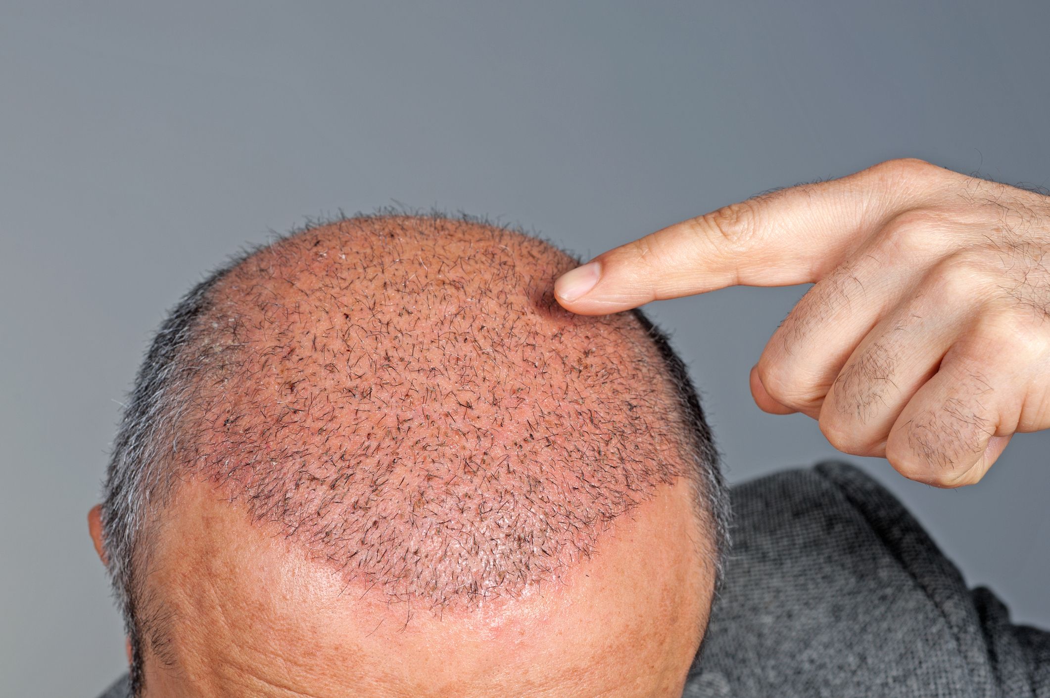 hair-transplant-royalty-free-image-164653183-1547124473.jpg