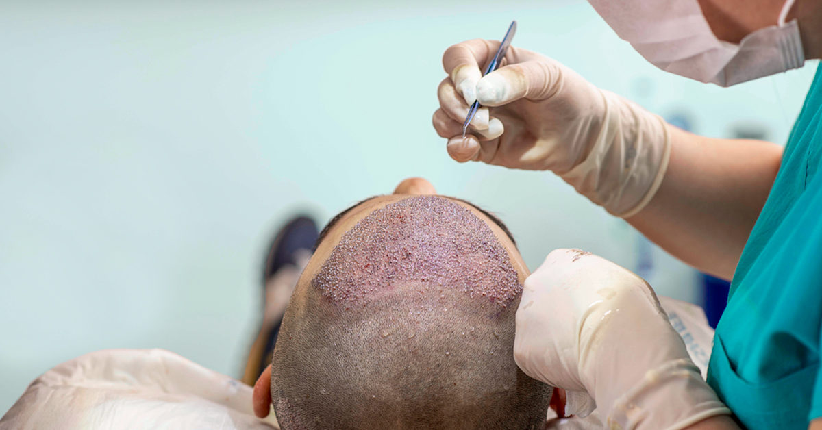 hair-transplant-surgery-1200x628-facebook-1200x628.jpg