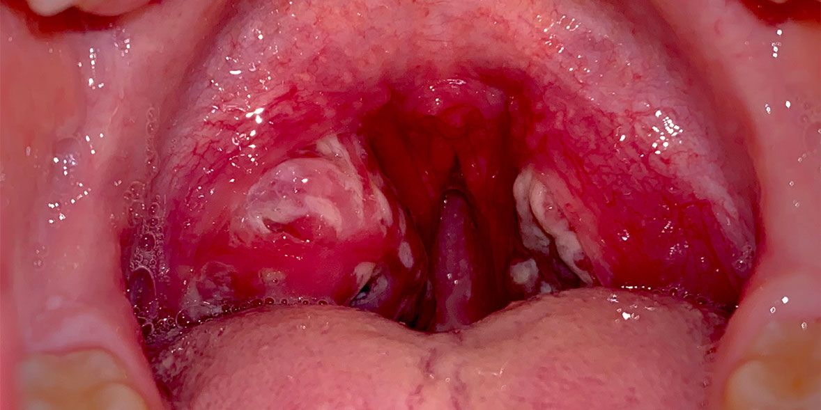 553478d9b2ad-child-with-strep-throat2.jpg