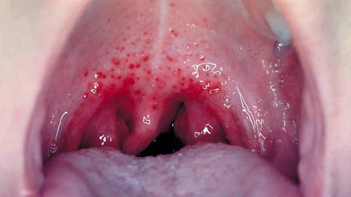 ingilterede-strep-aya-bagli-olumler-122ye-ulasti-7372-dhaphoto2.webp