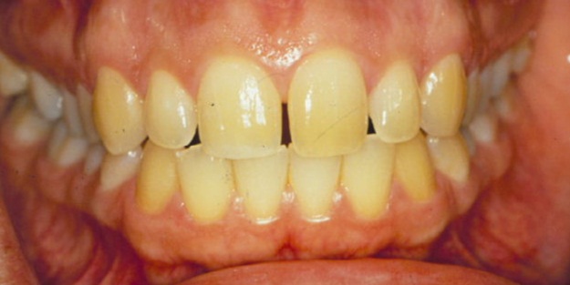 sararmis-dislere-cozum-h1486922879-379a7d.jpg