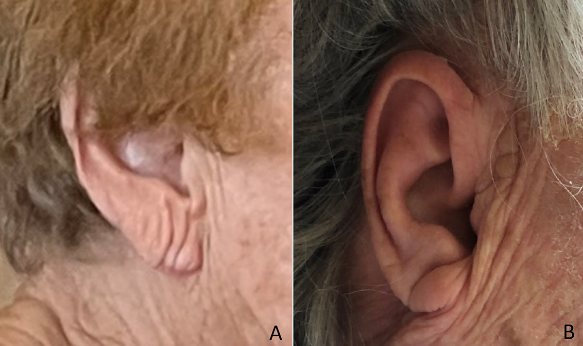 for-dwii-ear-lobe-crease-comparison-r.jpg