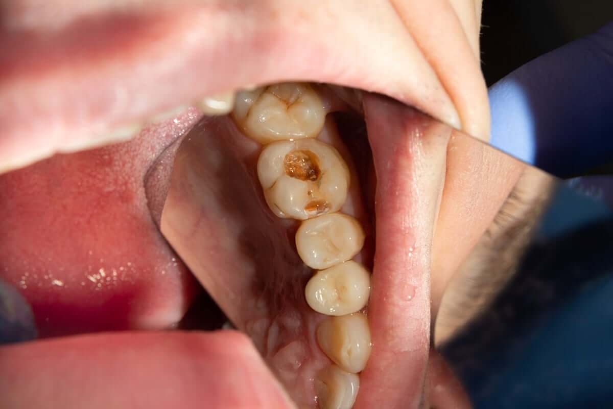 dentin-curugu-nasil-gecer.jpg