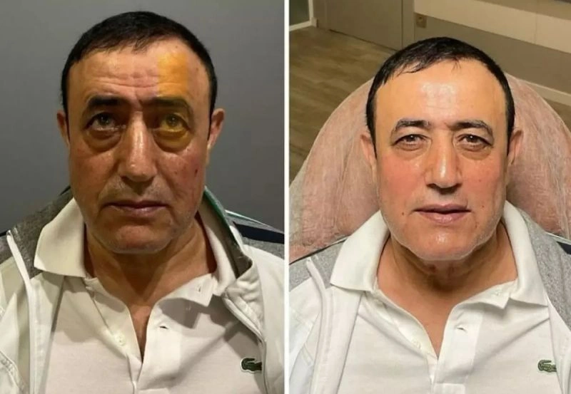 unlu-erkekler-estetik-mahmut-tuncer-rmtf.webp