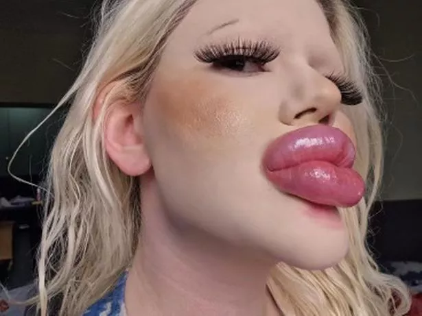 1-pay-woman-with-worlds-biggest-lips-undergoes-six-procedures-in-one-day.webp