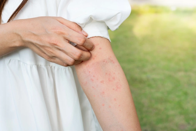 sivrisinek-isirigi-kasintisi-neden-olur-ne-iyi-gel-7240525.webp