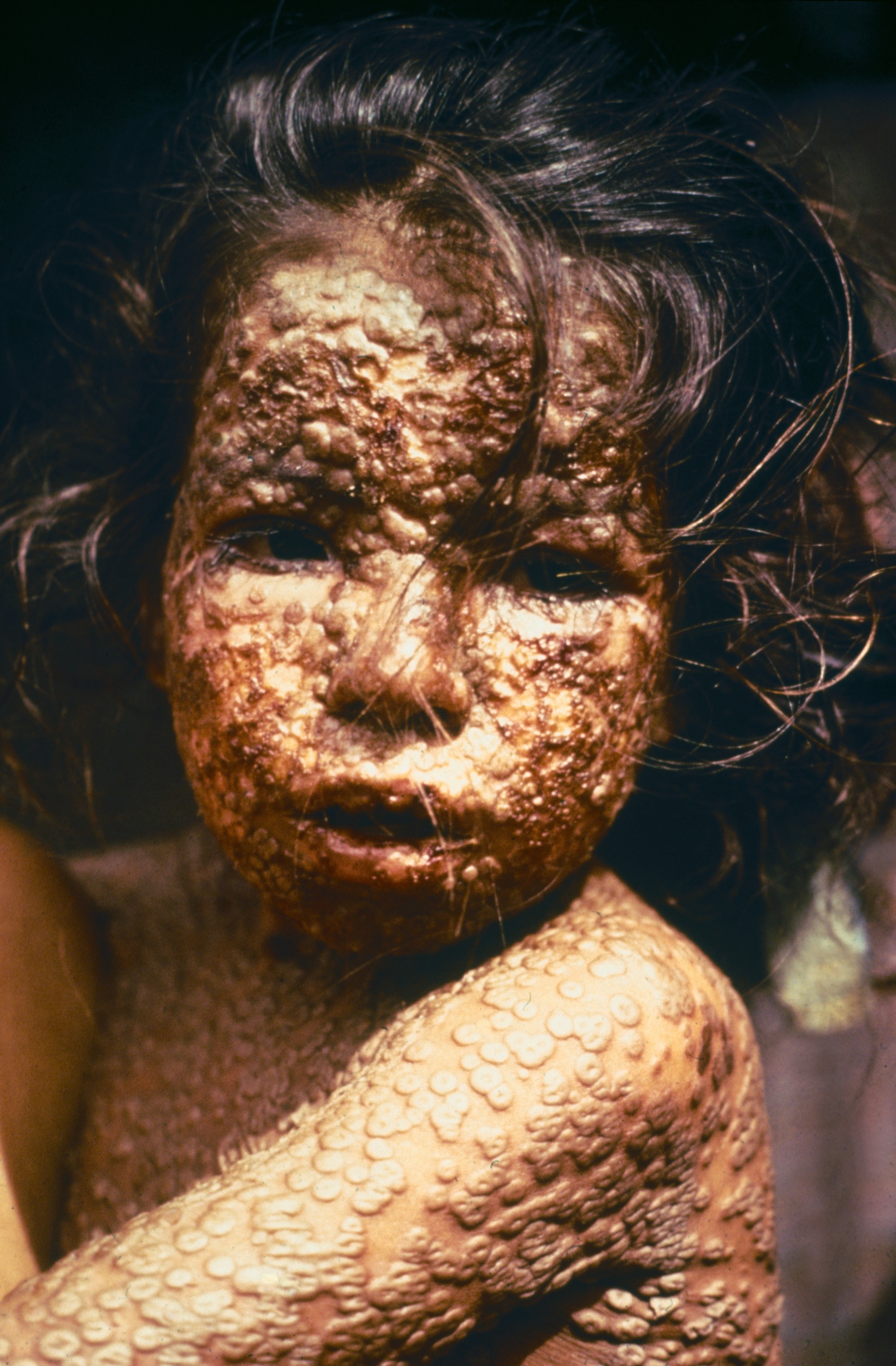 child-with-smallpox-bangladesh.jpg