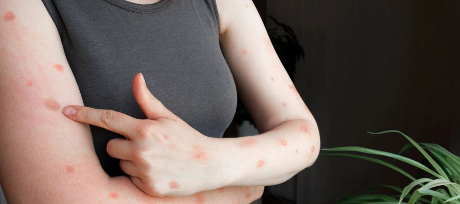 maymun-cicegi-mpox-virusu-nedir-220820241441253598593.webp