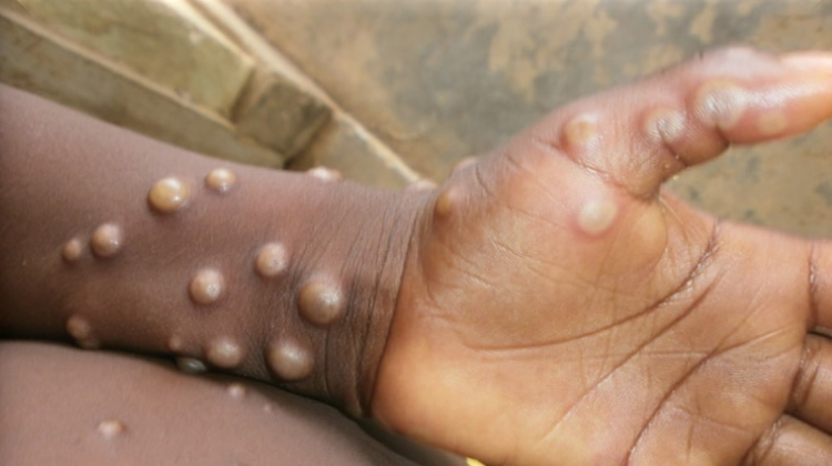 monkeypox.jpg