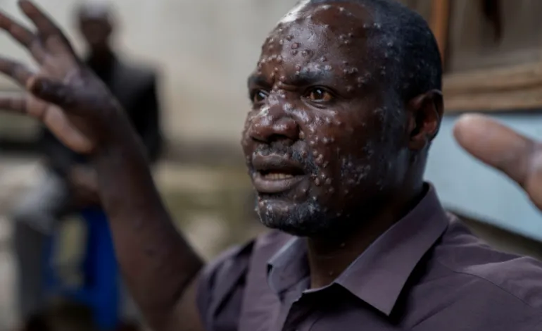 2024-07-24t083716z-743285404-rc2ew8anctvb-rtrmadp-3-health-mpox-congo-1723659248-770x470.png