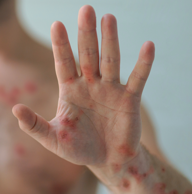 intro-pic-mpox-hand.png