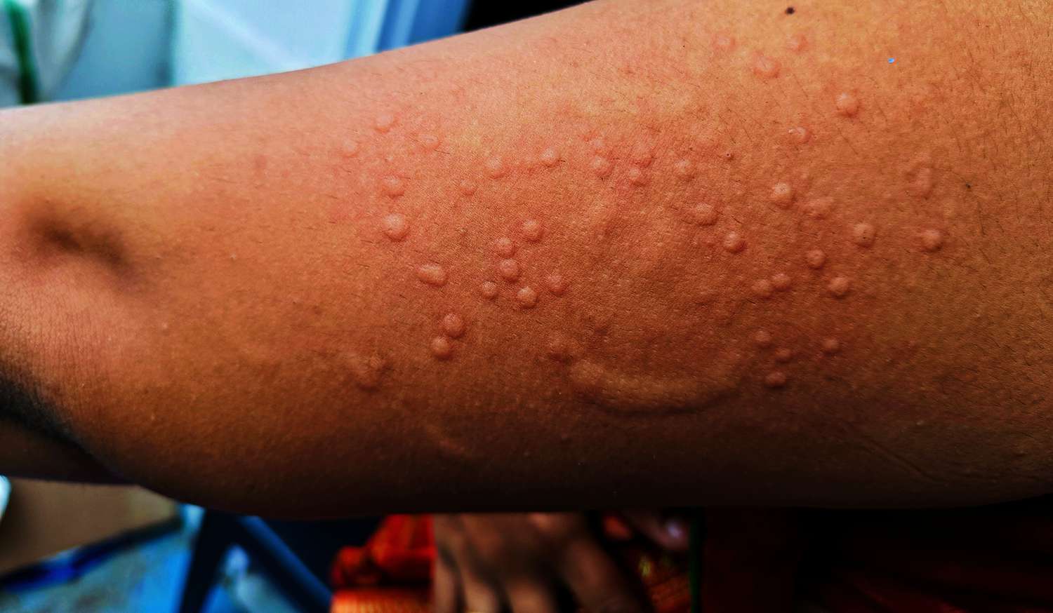 mpox.jpg