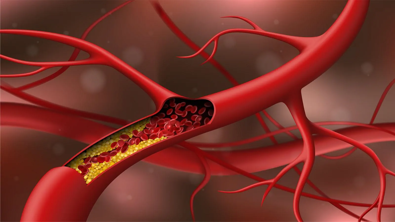 cholesterol-in-blood-vessel.webp