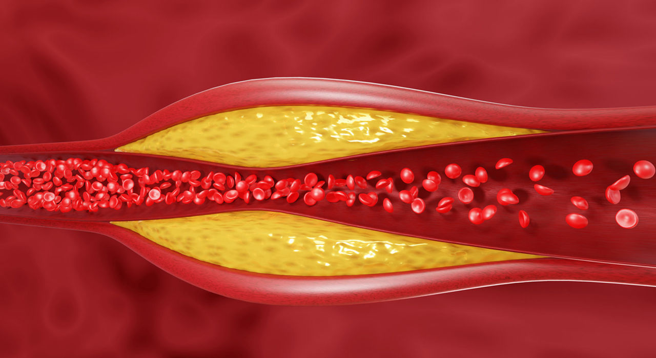 cholesterol-plaque-buildup-2200x1200.jpeg