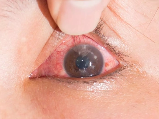 akut-glokom-krizi-44.webp